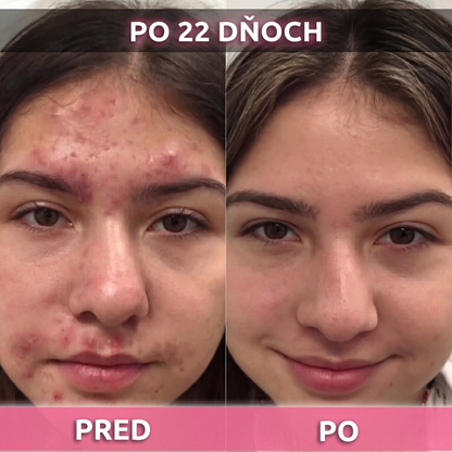 AkneMax (Veľmi rýchlo, v priebehu niekoľkých dní odstráni akné, vyrážky a čierne bodky)
