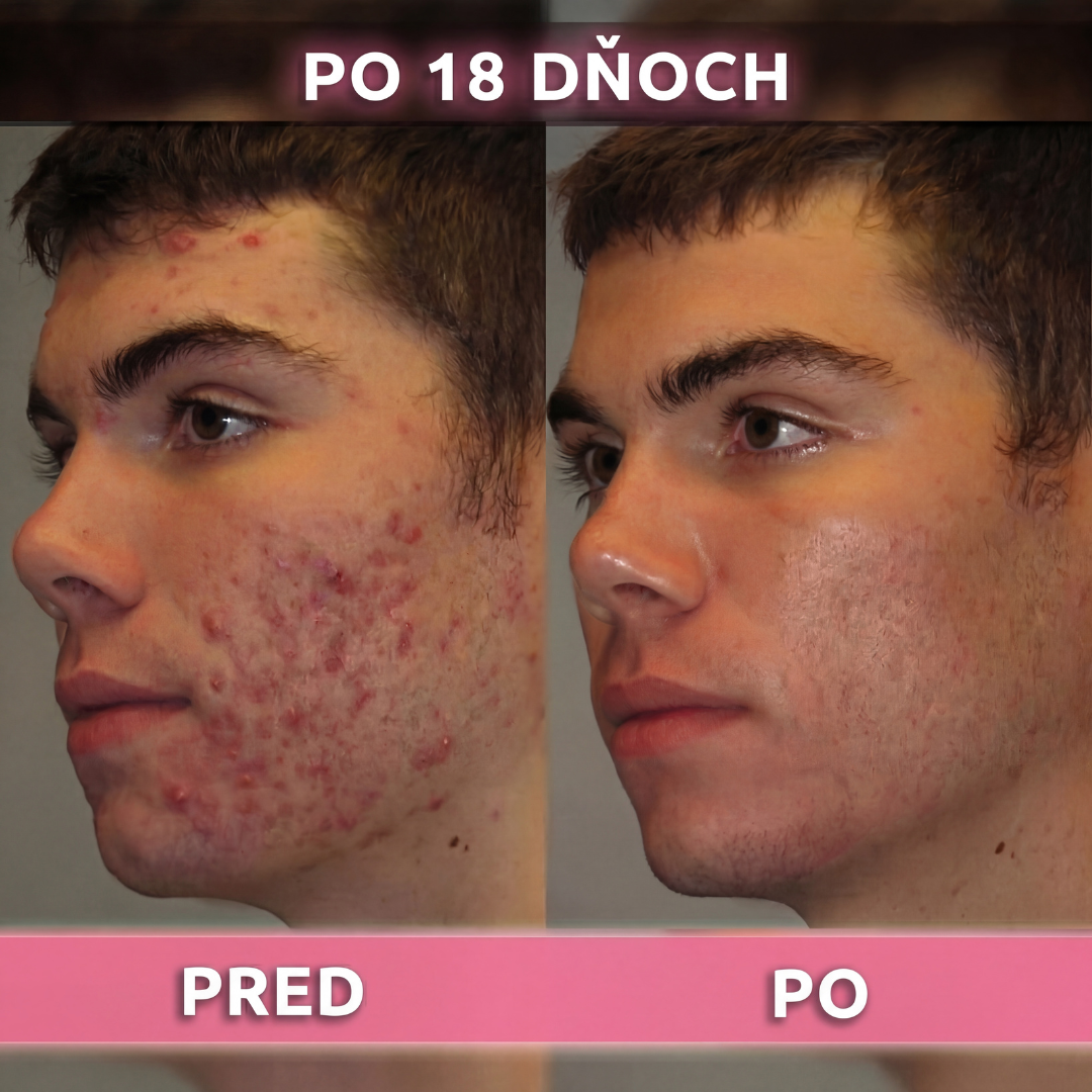 AkneMax (Veľmi rýchlo, v priebehu niekoľkých dní odstráni akné, vyrážky a čierne bodky)