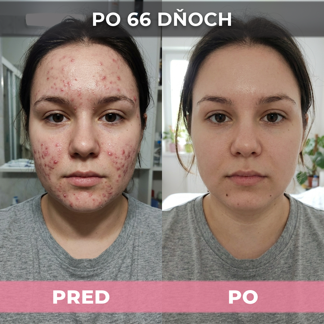 4 ks AkneMax (Veľmi rýchlo, v priebehu niekoľkých dní odstráni akné, vyrážky a čierne bodky)