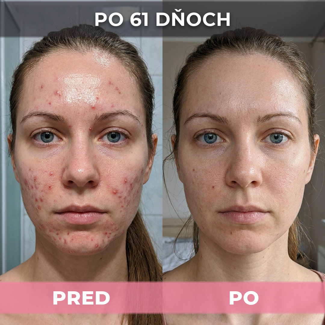 4 ks AkneMax (Veľmi rýchlo, v priebehu niekoľkých dní odstráni akné, vyrážky a čierne bodky)