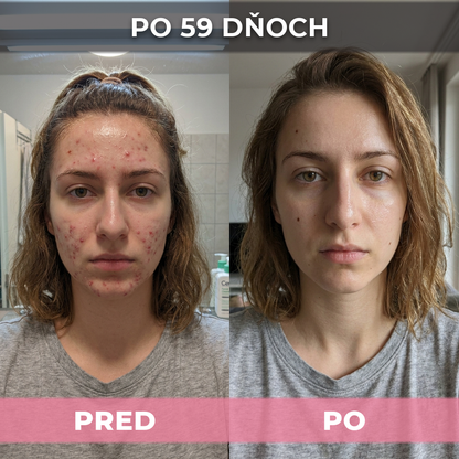 4 ks AkneMax (Veľmi rýchlo, v priebehu niekoľkých dní odstráni akné, vyrážky a čierne bodky)
