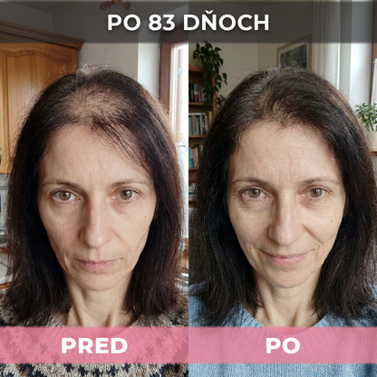 4 ks USA Hair Elixir Pre Ženy – Mimoriadne Účinne Naštartuje Rast Vlasov A Zastaví Ich Vypadávanie