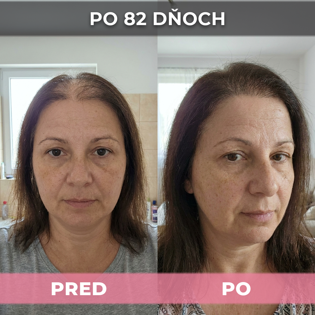 4 ks USA Hair Elixir Pre Ženy – Mimoriadne Účinne Naštartuje Rast Vlasov A Zastaví Ich Vypadávanie