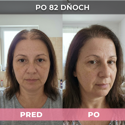 4 ks USA Hair Elixir Pre Ženy – Mimoriadne Účinne Naštartuje Rast Vlasov A Zastaví Ich Vypadávanie