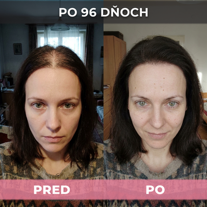 4 ks USA Hair Elixir Pre Ženy – Mimoriadne Účinne Naštartuje Rast Vlasov A Zastaví Ich Vypadávanie