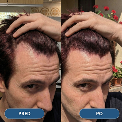USA Hair Elixir pre mužov – extrémne účinne naštartuje rast vlasov a zastaví ich vypadávanie