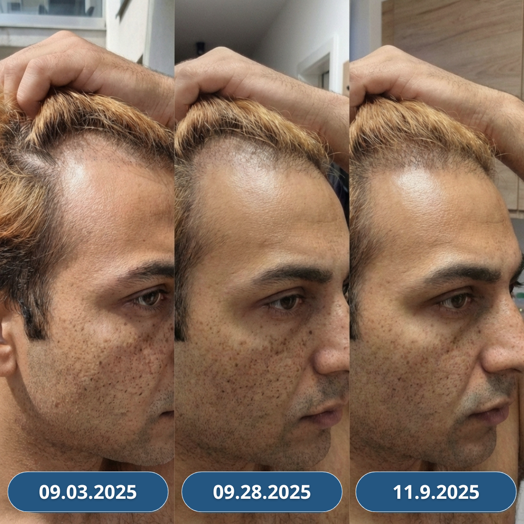 USA Hair Elixir pre mužov – extrémne účinne naštartuje rast vlasov a zastaví ich vypadávanie